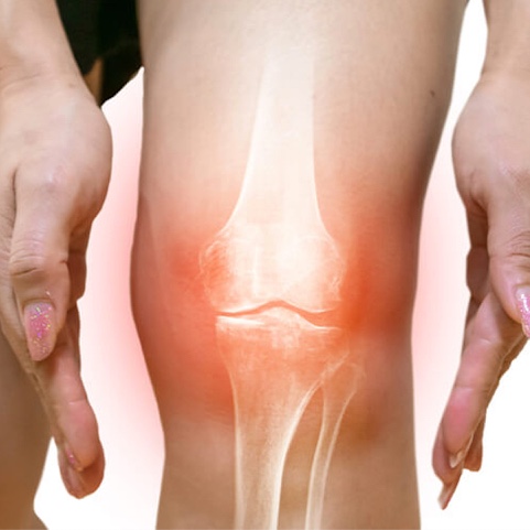 Knee Arthritis